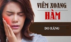 Khi n&#224;o cần nghĩ đến vi&#234;m xoang h&#224;m do răng?