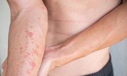 Cảnh gi&#225;c với vi&#234;m da tiếp x&#250;c dị ứng
