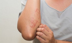 Mẩn đỏ, ngứa khắp người l&#224; biểu hiện của bệnh g&#236;?