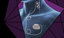 Lần đầu tiên tại Việt Nam thực hiện kỹ thuật điều biến dây thần kinh phế vị điều trị động kinh kháng thuốc