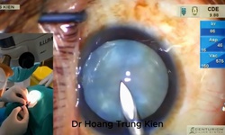 Đột ph&#225; mới trong phẫu thuật đục thủy tinh thể ch&#237;n trắng căng phồng