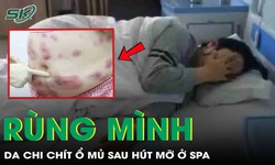 Rùng mình: Vùng da chi chít ổ mủ sau khi hút mỡ ở spa 