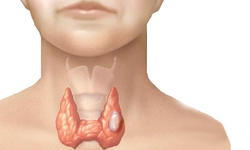 L&#253; do khiến bạn dễ mắc u tuyến gi&#225;p