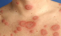 Phát hiện kịp thời trẻ mắc lupus ban đỏ hệ thống