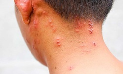 Đắp lá hay điều trị zona thần kinh theo mẹo dân gian có thể đe dọa tính mạng