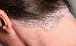 Ai dễ bị nhiễm nấm da đầu, biểu hiện nấm da đầu?