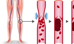 7 dấu hiệu cảnh b&#225;o sớm cục m&#225;u đ&#244;ng, ph&#242;ng ngừa như thế n&#224;o?