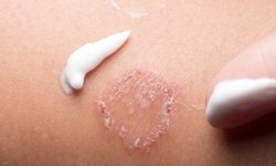 Dấu hiệu nổi bật của bệnh lác đồng tiền và cách xử trí