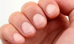 5 dấu hiệu trên móng tay có thể tiết lộ tình trạng sức khỏe của người nhiễm HIV