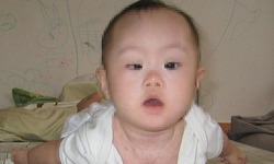 Trẻ mệt bất thường có thể mắc rối loạn nhược cơ bẩm sinh