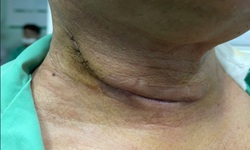 Ph&#225;t hiện mắc c&#249;ng l&#250;c 2 loại ung thư sau 6 th&#225;ng kh&#224;n tiếng