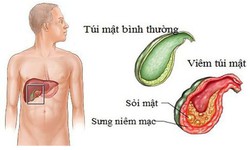 Dấu&#160;hiệu&#160;của&#160;vi&#234;m&#160;t&#250;i&#160;mật&#160;theo&#160;từng&#160;giai&#160;đoạn