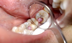 Biến chứng nguy hiểm của vi&#234;m tuỷ răng