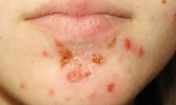 Ph&#242;ng bệnh chốc lở ngo&#224;i da m&#249;a mưa