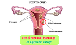 U xơ tử cung dưới thanh mạc c&#243; nguy hiểm kh&#244;ng?