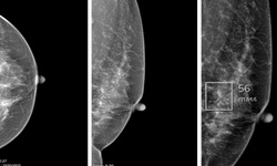 Ph&#225;t hiện sớm ung thư v&#250; nhờ c&#244;ng nghệ AI