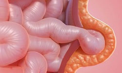 Thoát vị bẹn cần phát hiện sớm để tránh biến chứng nguy hiểm