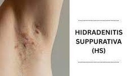 Thuốc trị vi&#234;m tuyến mồ h&#244;i mủ