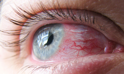 Bỏng mắt có biểu hiện như thế nào?