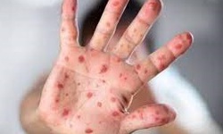 Cảnh gi&#225;c với nguy cơ bệnh sởi &#39;trở lại to&#224;n cầu&#39;