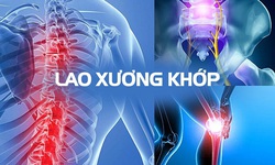 Ai l&#224; người dễ bị lao xương khớp?