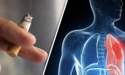 9 ca ung thư phổi đầu ti&#234;n từ nghi&#234;n cứu mới ở Singapore đều l&#224; người kh&#244;ng h&#250;t thuốc