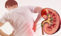 Đau lưng &#226;m ỉ một năm, người đ&#224;n &#244;ng 54 tuổi ph&#225;t hiện thận bị ph&#225; hủy bởi sỏi san h&#244; khổng lồ