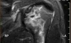 Thợ lặn biển hơn 20 năm bị hoại tử xương c&#225;nh tay, xương đ&#249;i