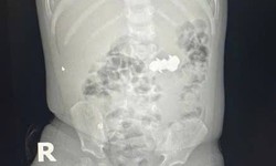 B&#233; trai nuốt 4 vi&#234;n đinh nam ch&#226;m đầu nhọn nguy hiểm
