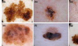 Dấu hiệu ung thư tế bào hắc tố ở da