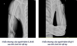 Cảnh b&#225;o nguy cơ gẫy xương c&#225;nh tay từ tr&#242; vật tay