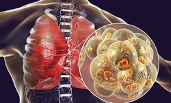 4 triệu chứng điển h&#236;nh cảnh b&#225;o mắc vi&#234;m phổi