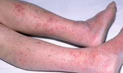 Viêm não mô cầu: Căn bệnh nguy hiểm có thể gây tử vong trong 24 giờ xuất hiện tại Hà Nội