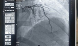 Hồi sinh sự sống cho cụ &#244;ng 70 tuổi bị nhồi m&#225;u cơ tim cấp trong đ&#234;m