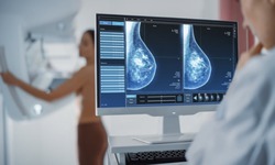 Tầm so&#225;t ung thư: Khi n&#224;o l&#224; cần, khi n&#224;o l&#224; lạm dụng?