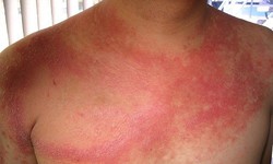 Biến chứng nguy hiểm của lupus ban đỏ hệ thống