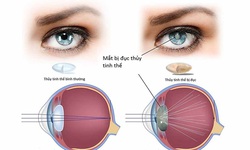 Dấu hiệu điển hình nhận biết đục thủy tinh thể