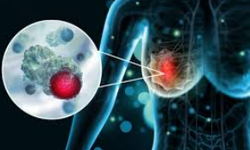 Nghiên cứu vaccine mới mở ra hy vọng chống lại ung thư vú thể nguy hiểm nhất