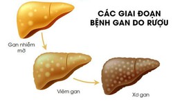 Thói quen âm thầm huỷ hoại lá gan mà đàn ông Việt hay mắc phải