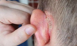 Vành tai đỏ, ngứa, khô da và bong tróc cảnh giác với bệnh chàm tai