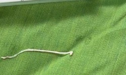 Phẫu thuật khối u, phát hiện ký sinh trùng dạng sán trong vùng hố chậu bệnh nhân