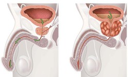 Phì đại tuyến tiền liệt lành tính khi nào nguy hại?