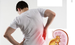 Sỏi tiết niệu có thể gây ra những hậu quả gì?