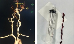 Cứu cụ bà 75 tuổi đột quỵ nhồi máu não thoát lằn ranh sinh tử