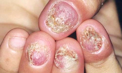 Điều trị hiệu quả nấm móng tay, móng chân