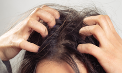 Da đầu gàu – ngứa kéo dài: 6 nguyên nhân ít ai ngờ tới khiến vấn đề trở nặng