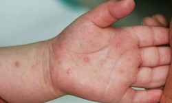 Những biến chứng đáng sợ của bệnh tay chân miệng