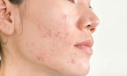 Top gel ngừa mụn được nhiều người lựa chọn trong năm 2025