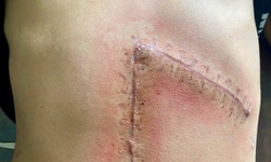 Cứu sống thiếu ni&#234;n sốc mất m&#225;u do vỡ l&#225;ch độ 5 sau tai nạn giao th&#244;ng