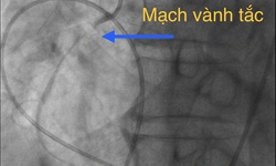 Cứu sống bệnh nh&#226;n 70 tuổi v&#236; nhầm nhồi m&#225;u cơ tim với &#39;tr&#250;ng gi&#243;&#39;